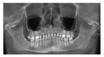 Перелом зуба и подвижность фото 1
