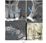 Перелом зуба и подвижность фото 2