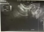 Расшифровка трансвагинального УЗИ на наличие/отсутствие беременности фото 2
