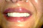 Липофилер область верхней губы. Образовалось уплотнение фото 1