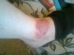 Красное пятно на ноге чешется, консультация дерматолога фото 2