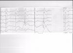 В анамнезе инфаркт миокарда 2008. Расшифровка ЭКГ и БХК фото 2