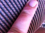 Сыпь на пальце, экзематозный дерматит на пальце фото 2