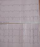 Лечение мерцательной аритмии, расшифровка ЭКГ и УЗИ сердца фото 2