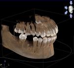 Имплантация зуба при остеоме фото 1