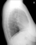 Ковид рентгенограмма легких в прямой и боковой проекциях фото 4