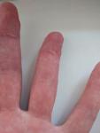 Последствия открытого перелома 4 пальца левой кисти фото 2