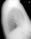 Ковид рентгенограмма легких в прямой и боковой проекциях фото 3