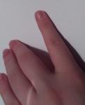 Шишка на пальце от ушиба фото 4