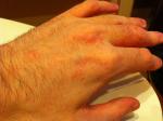 Раздражение кожи кистей рук фото 4