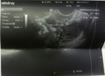 Расшифровка трансвагинального УЗИ на наличие/отсутствие беременности фото 3