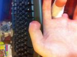 Удлинение фаланги большого пальца руки фото 3