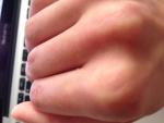 Травма среднего пальца руки фото 3