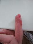Последствия открытого перелома 4 пальца левой кисти фото 4