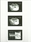 Медрол 4мг в первом триместре беременности фото 1