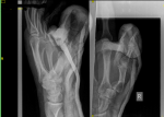 Перелом пальца руки фото 1