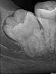 Парастезия после удаления зуба мудрости на нижней челюсти справа фото 1