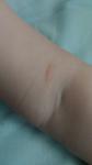 Красное пятно на руке у ребёнка, неизвестный дерматит фото 1