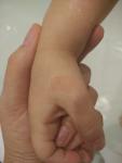 Шершавое пятно на руке у ребенка 3 лет фото 1