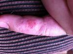 Сыпь на пальце, экзематозный дерматит на пальце фото 1