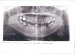 Депульпированный зуб болит фото 1