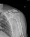 Перелом большого бугорка плечевой кости фото 2