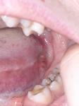 Боль языка, пятно на щеке, боюсь онкологии фото 3
