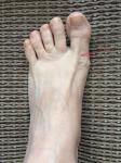 Боль в ноге в районе большого пальца и шишки фото 1