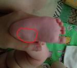 Симметричные шишки на ножках ребенка фото 3