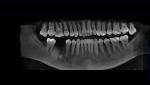 Имплантация зуба при остеоме фото 2
