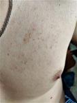 Зудящая сыпь на груди и теле после ванны фото 4