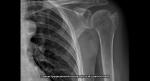 Повреждение плечевой кости фото 1