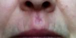 Травма верхней губы фото 1