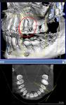 Корень зуба вне костной ткани фото 1