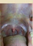 Першение в горле, увеличенные сосуды фото 1