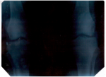 Описание снимка коленного сустава (ширина суставной щели) фото 2