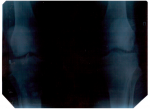Описание снимка коленного сустава (ширина суставной щели) фото 3
