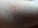 Высыпание на коже после прививки Спутник фото 1