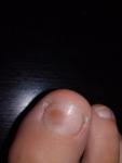 Потемнели участки на ногтях больших пальцев ног фото 1