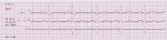 Помогите расшифровать кардиограмму и найти причину болей в сердце фото 1