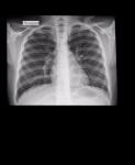 Расшифровка рентгена грудной клетки фото 1