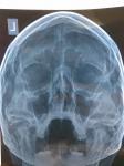 Посттравматическое искривление перегородки носа. Разные диагнозы рентгенолога и ЛОра фото 4