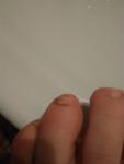 Грибок ногтя безымянного пальца фото 1