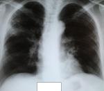Рентгенограмма ОГК фото 1