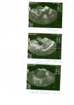 По результатам УЗИ эндометриозная киста фото 2