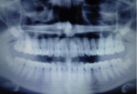 Болит зуб при надавливании фото 2