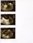 Диагноз УЗИ: кистома левого яичника фото 3