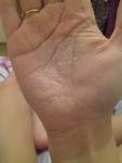 Воспаление кожи рук фото 1
