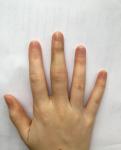 Не проходит боль и отёк после перелома пальца руки фото 1