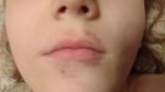 У ребенка 8 лет пятна вокруг губ, похожие на кровоизлияние фото 1
